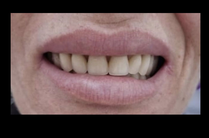 Antes e Depois 1