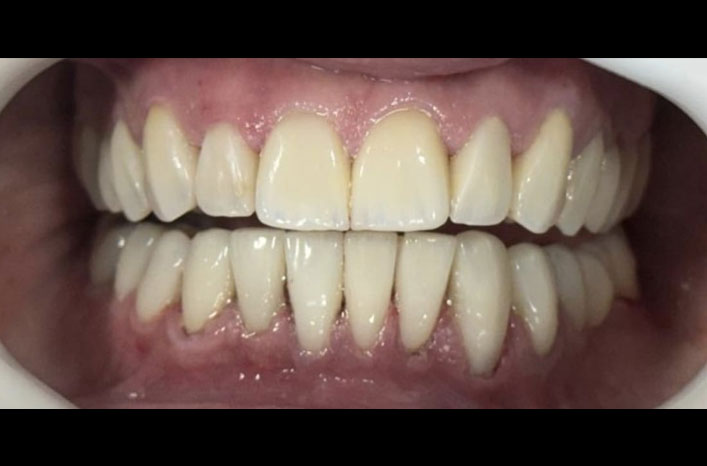 Antes e Depois 4